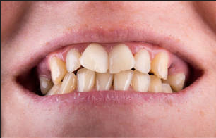 dental implants in india